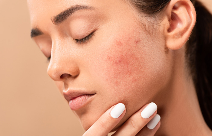 Woman with skin blemishes may benefit from cheese diet