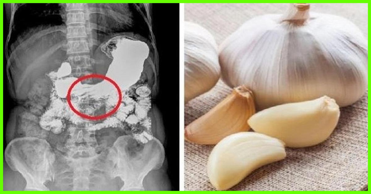 Garlic Side Effects: 14 Ways It May Cause Harm