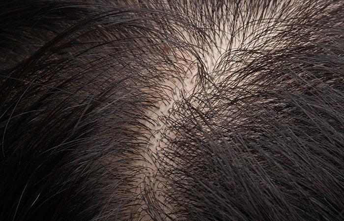 10 Side Effects Of Hair Transplantation You Should Be Aware Of