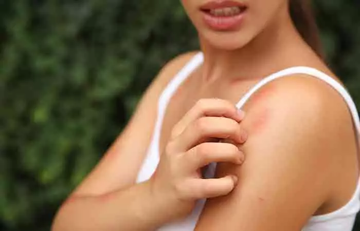 A woman scratching an insect bite on her shoulder
