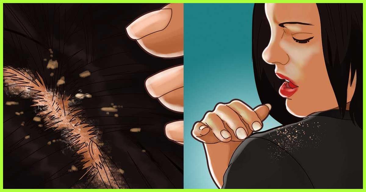 How Does Garlic Help Control Dandruff?