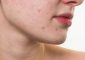 6 Natural Ways To Treat Red Spots On ...