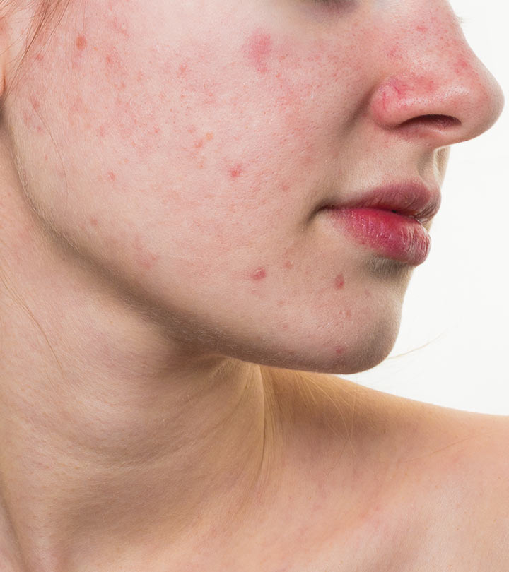 Pimples on redness reduce to to put what Home Remedies