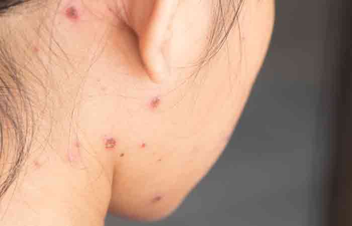 A woman covered with chickenpox blisters