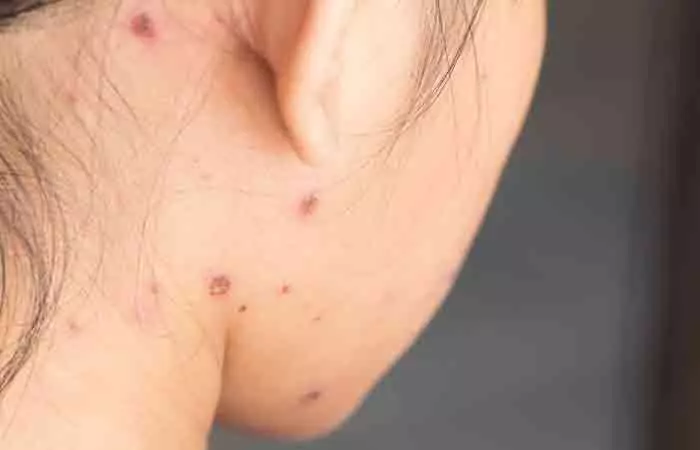 A woman covered with chickenpox blisters