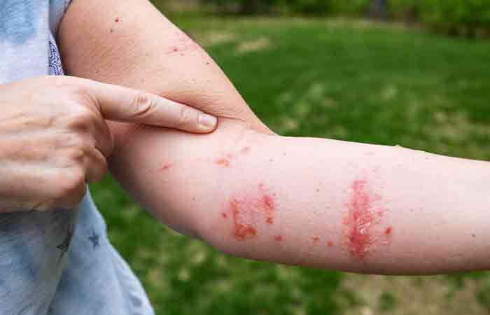 A woman with poision ivy rash