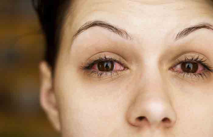 Woman with sore eyes may benefit from honey 