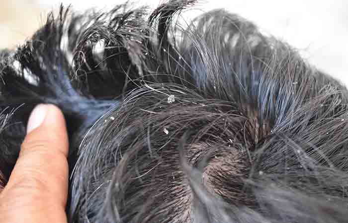 Close up of dandruff in hair as a serious side effect of overusing hair gel