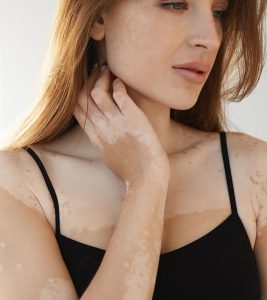 White Spots On Skin (Vitiligo) – Ca...