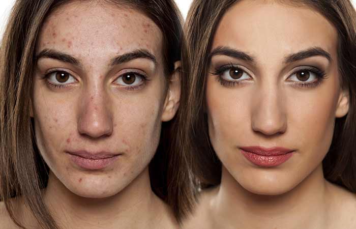 Nasıl Yapılır-al-Rid-Of-Pimples2