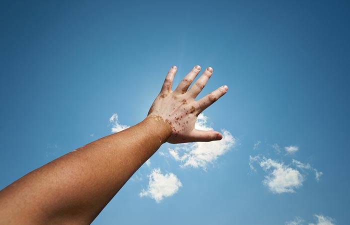 Person with vitiligo holding their hand up in sunlight