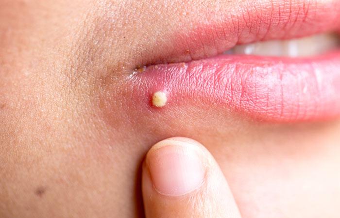 how-to-get-rid-of-lip-pimple-useful-tips