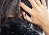 6 Best Hair Oils For Dandruff – Control The Itching & Flaking