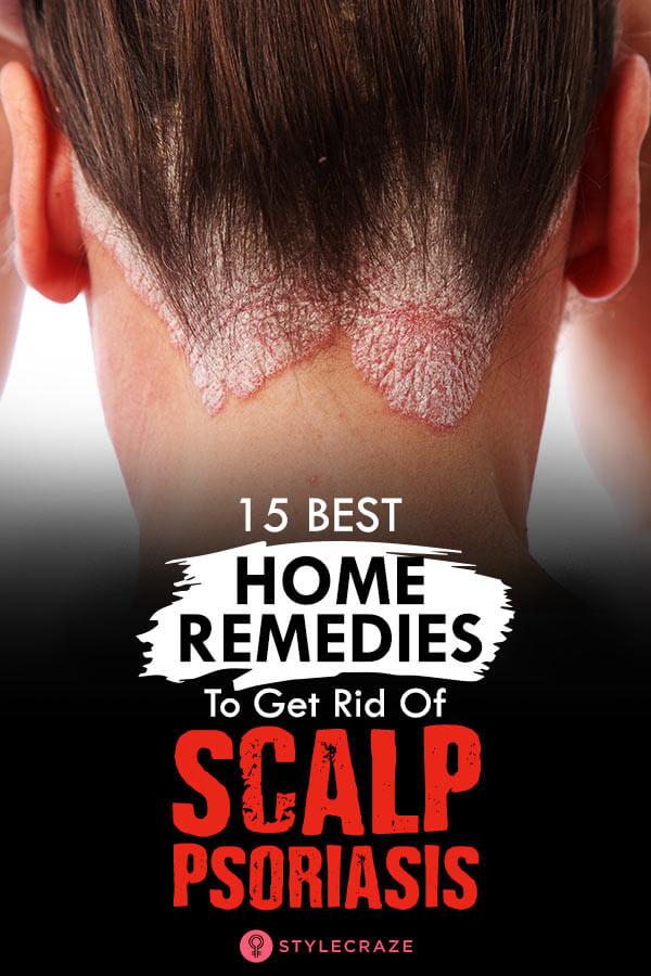 12 Best Home Remedies To Improve Scalp Psoriasis Effectively