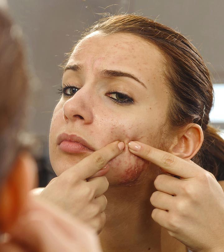 5 Simple But Very Effective Acne Vulgaris Treatments