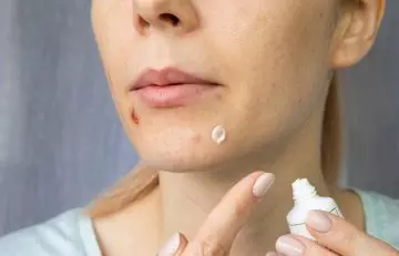 Woman applying ointment on her chin acne