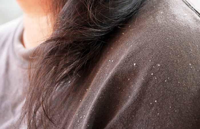 Dry dandruff