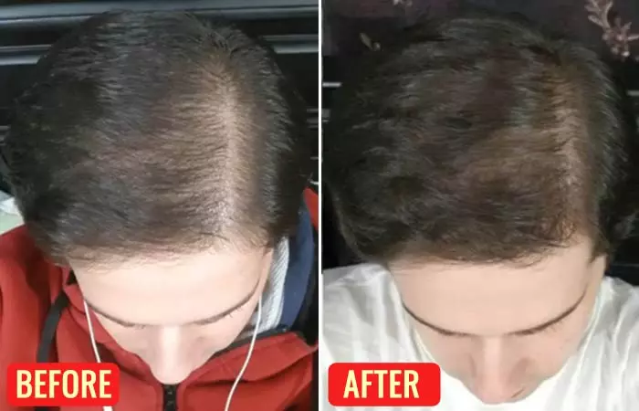 Before and after using emu oil for hair loss 2