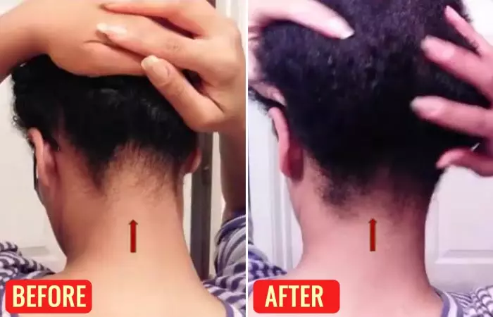 Before and after using emu oil for hair loss 3