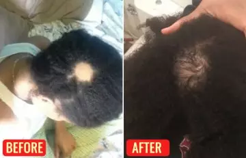 Before and after using emu oil for hair loss 1