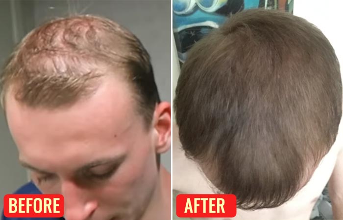Before and after using emu oil for hair loss 4