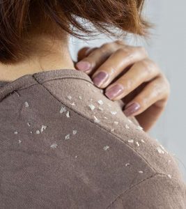 How To Get Rid Of Dandruff In Winter Naturally