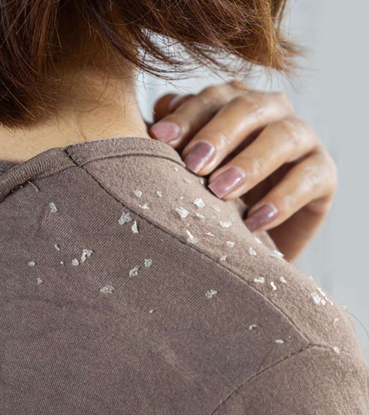Dandruff In Winter? Ways To Prevent It Naturally
