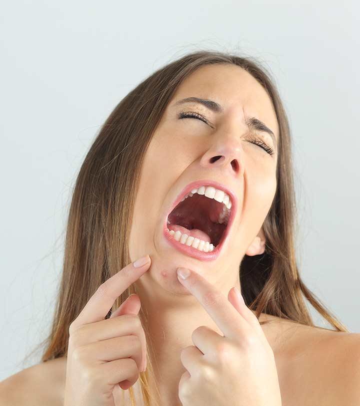 Chin Acne: What Is It, Causes, And How To Treat It