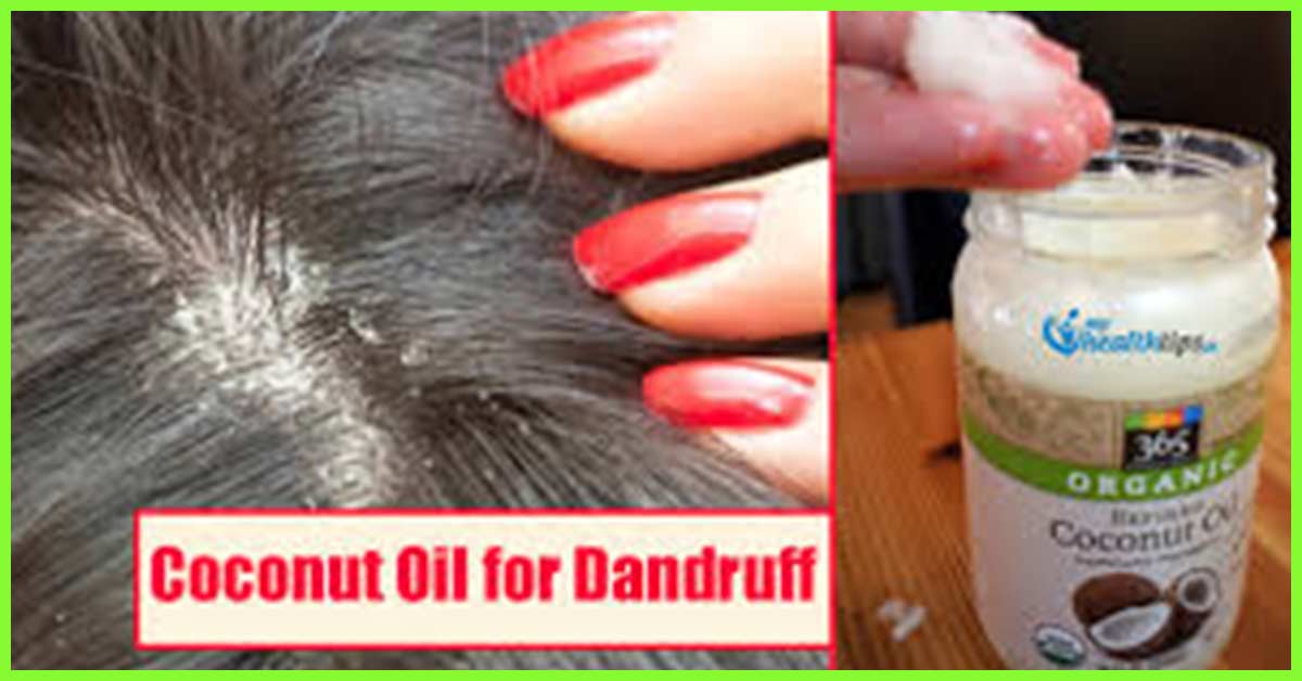 How To Use Coconut Oil For Dandruff