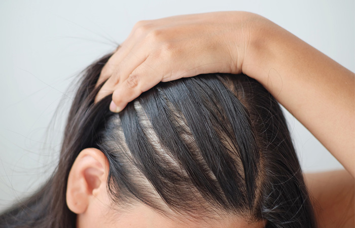 Ozone therapy can reduce hair thinning