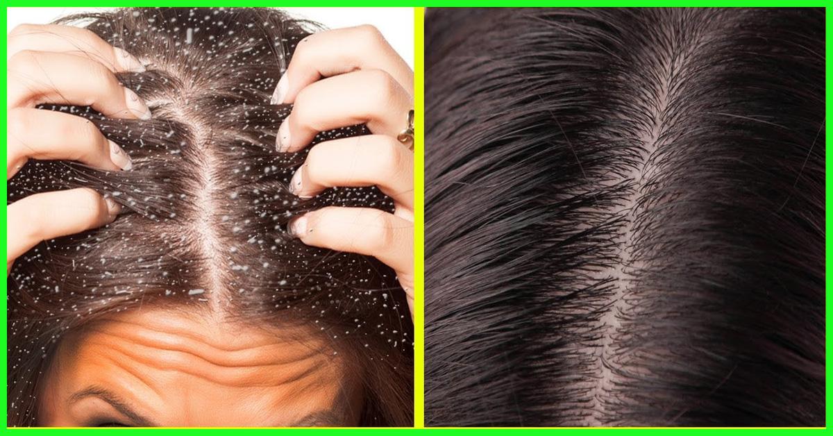 Top 5 Symptoms Of Dandruff