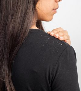 Symptoms Of Dandruff, Its Types, Causes, ...