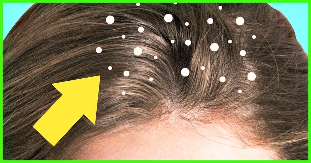 Top 10 Anti Dandruff Conditioners Available In India