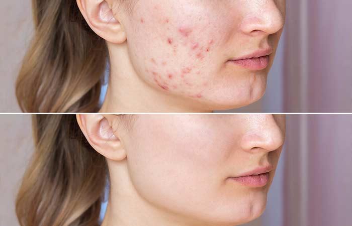 Treatment of Acne