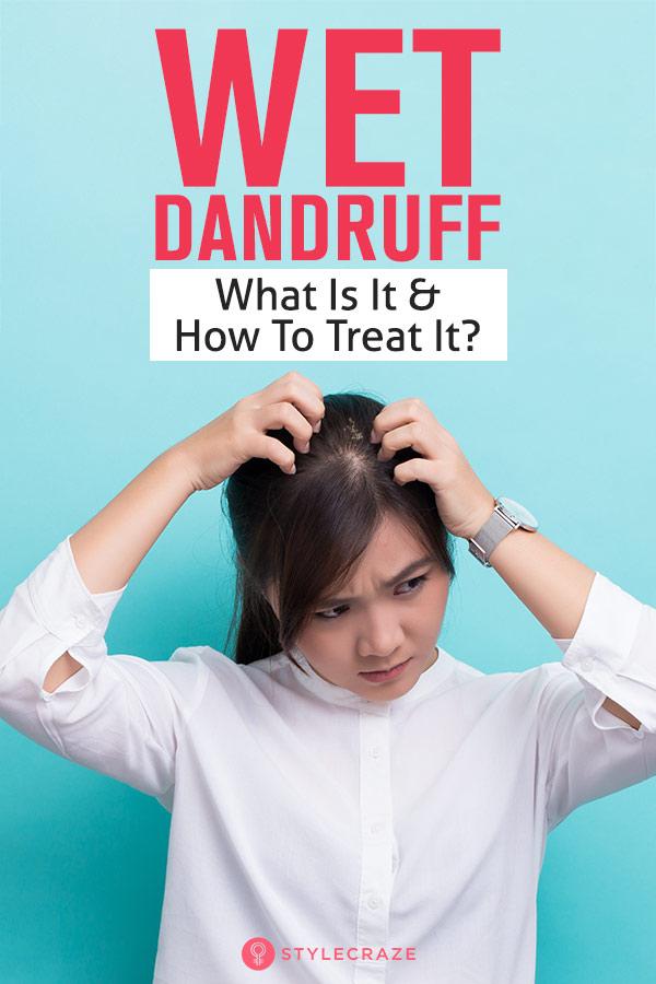 Wet Dandruff What Is It And How To Treat It 5 Home Remedies