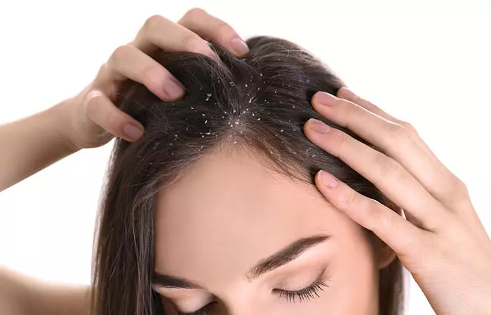 Close up of a woman with dandruff on her scalp and hair