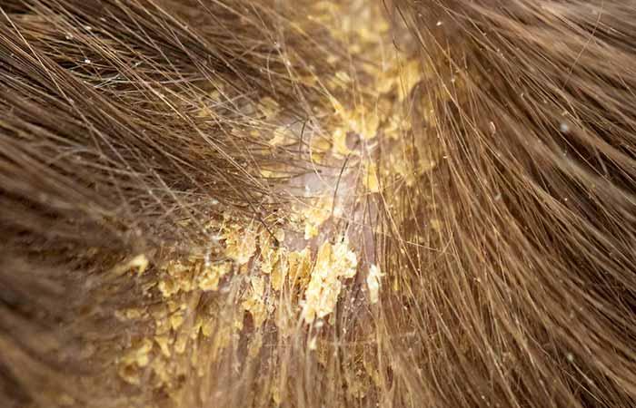 Wet Dandruff: What Is It And How To Treat It? - 5 Home Remedies