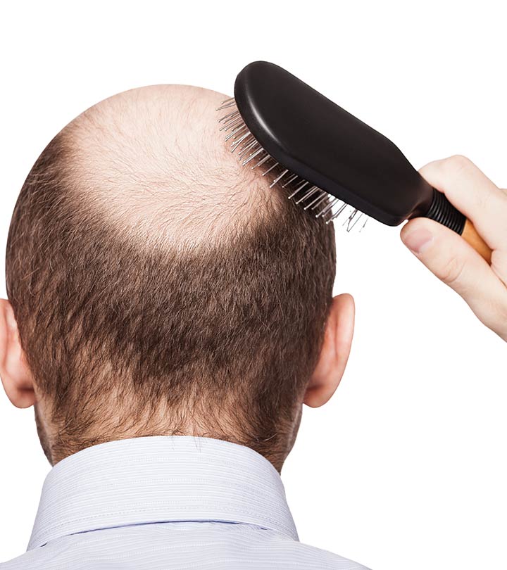 What Is Dht Hair Loss And How To Treat It