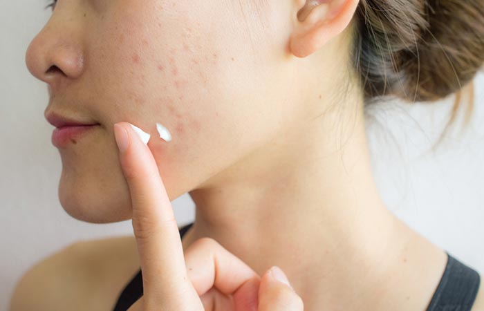 A woman applying Mederma for acne scars