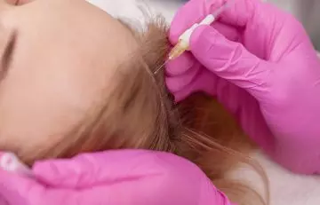 Woman getting ozone therapy for hair growth