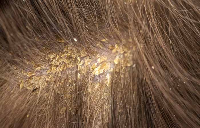 Wet Dandruff - does not cause redness or irritation 