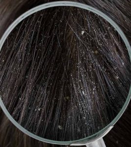 What Are The Different Types Of Dandruff Flakes And How To Stop Them?