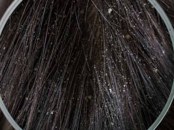 What Are The Different Types Of Dandruff Flakes And How To Stop Them?