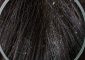 Different Types Of Dandruff And How T...