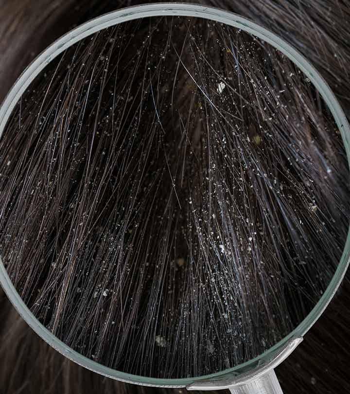 Sinha Hair  If you have a dry flaking scalp you may suspect dandruff  But it could be a sign of dry scalp Dandruff and dry scalp have the same  main symptoms