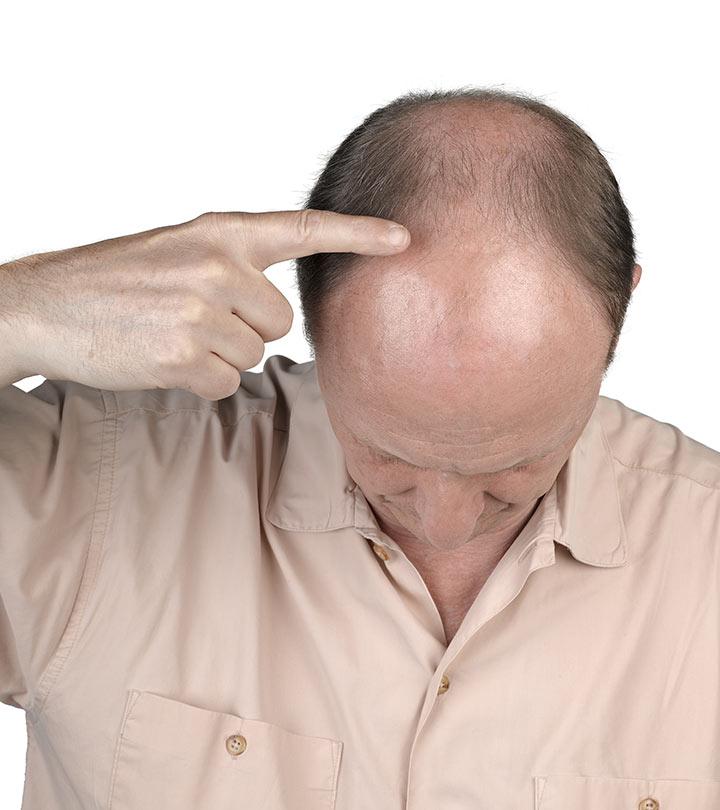 Balding Stock Photos Royalty Free Balding Images  Depositphotos