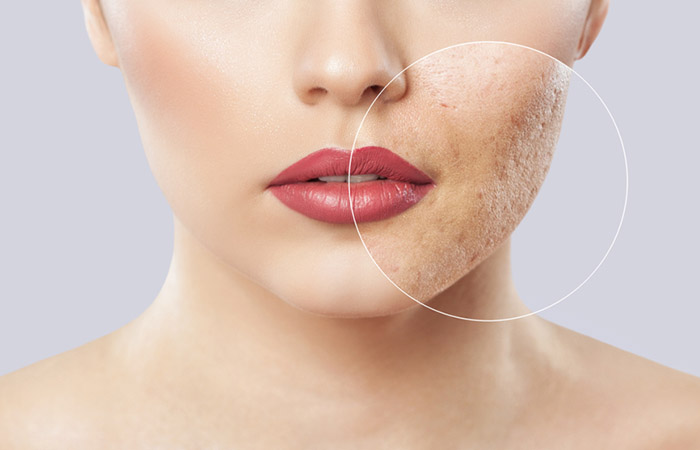Laser treatment improves skin texture