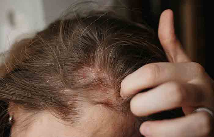 Woman with psoriosis scratching scalp 