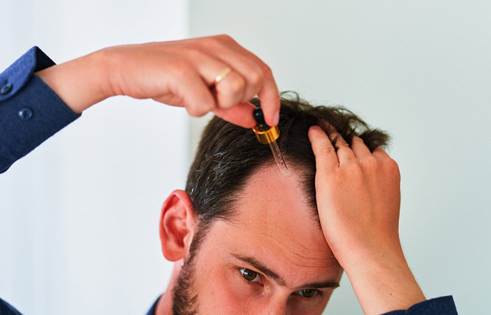 Man applying Minoxidil to tackle frontal hair loss