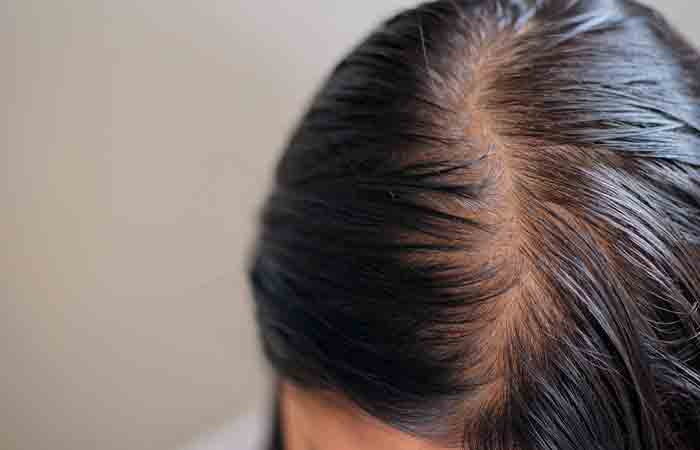 Woman with oily scalp and dandruff